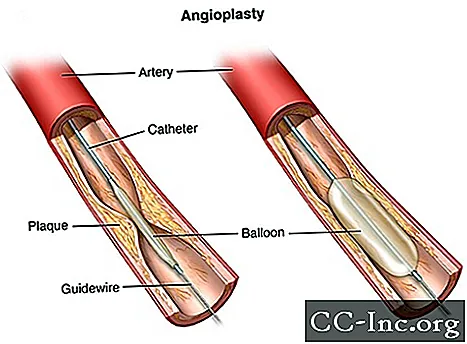 Angioplastik och stentplacering för hjärtat