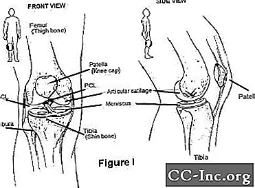 Verletzung oder Riss des vorderen Kreuzbandes (ACL)
