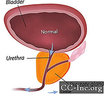 Godartet prostatahyperplasi (BPH)