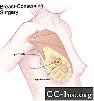 جراحة المحافظة على الثدي (استئصال الكتلة الورمية)