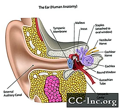 Cochlear implantaadi operatsioon