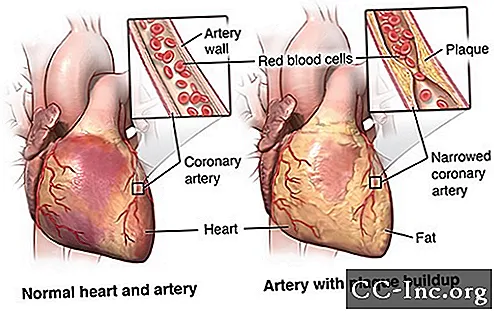 Koronāro artēriju šuntēšanas operācija