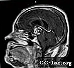 Craniopharyngioma