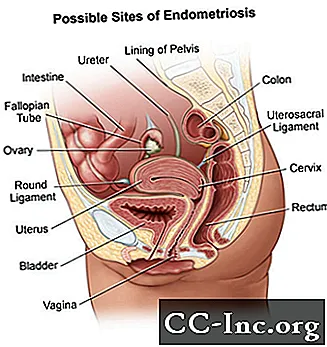 Endometrioosi