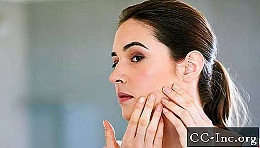 Har du vuxen acne? Få svar från en expert