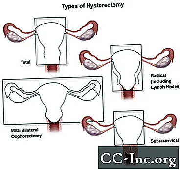 Hysterektomi