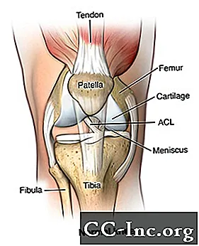 Ремонт на връзката на коляното