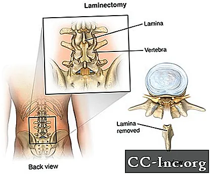 Laminectomía