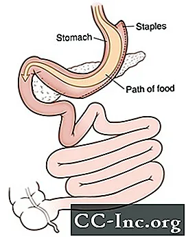 Panoramica della gastrectomia a manica laparoscopica