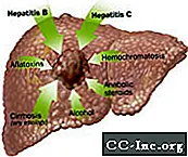 سرطان الكبد (سرطان الخلايا الكبدية)