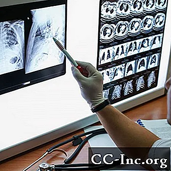 Detección de cáncer de pulmón