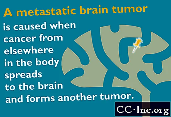 Metastatisk hjärntumör: 6 saker du behöver veta