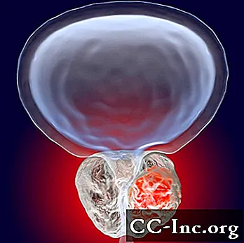 Diagnóstico de câncer de próstata - Saúde