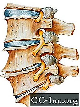 Spinalni artritis (artritis v hrbtu ali vratu)