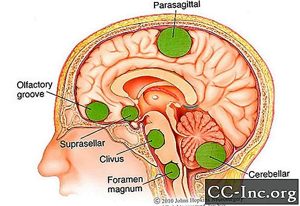 가장 흔한 뇌종양 : 알아야 할 5 가지
