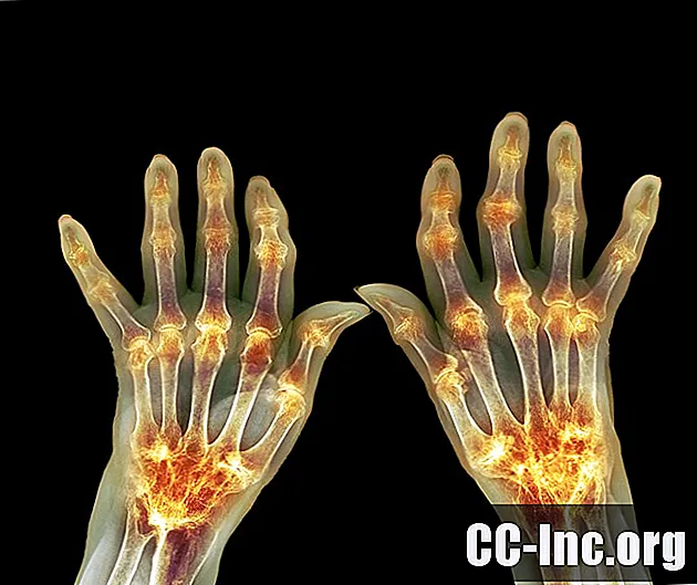 10 cose che devi sapere e capire sull'artrite