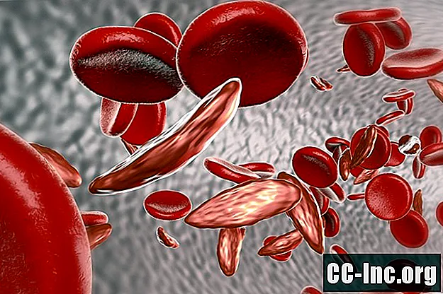 10 أشياء يجب أن تعرفها عن مرض فقر الدم المنجلي