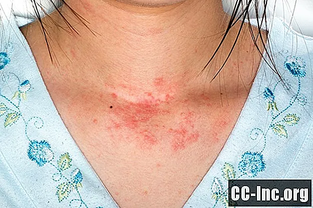 3 najpogostejše vrste alergijskih kožnih izpuščajev