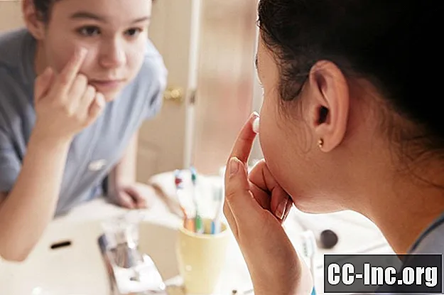 5 formas de preservar su autoestima a pesar del acné - Medicamento