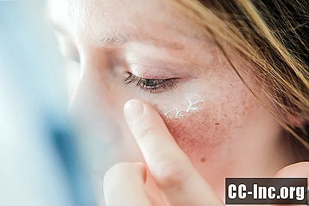 6 måter å behandle tørr hud forårsaket av benzoylperoksid