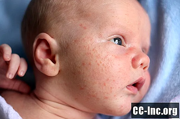 Leitfaden für Eltern zur Akne bei Kindern (Babyakne)