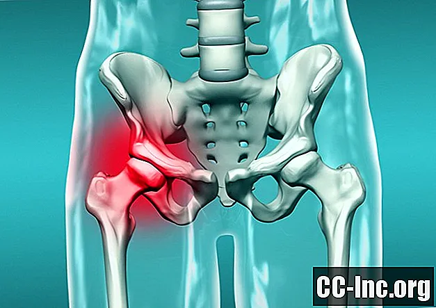 La frattura acetabolare è una presa dell'anca rotta