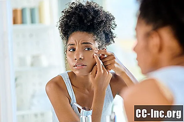 Wskazówki dotyczące leczenia trądziku dla skóry afroamerykańskiej