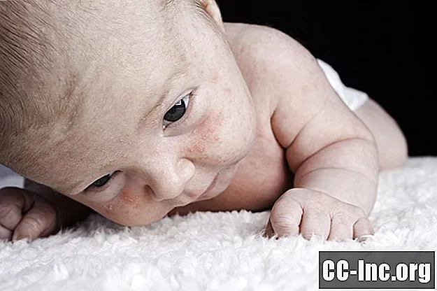 Acne bij baby's, kinderen, tieners en volwassenen - Geneesmiddel