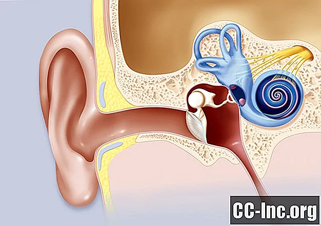 聴神経腫の症状、診断、および治療