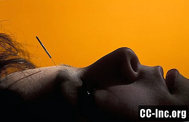 Akupunktur und Migräne