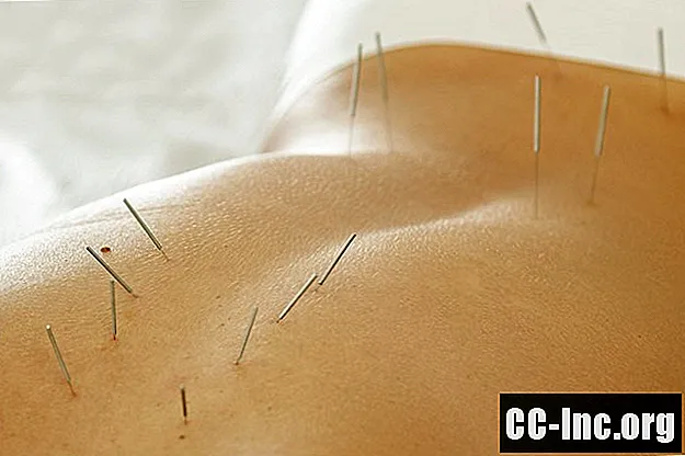 Akupunktur för cancerpatienter