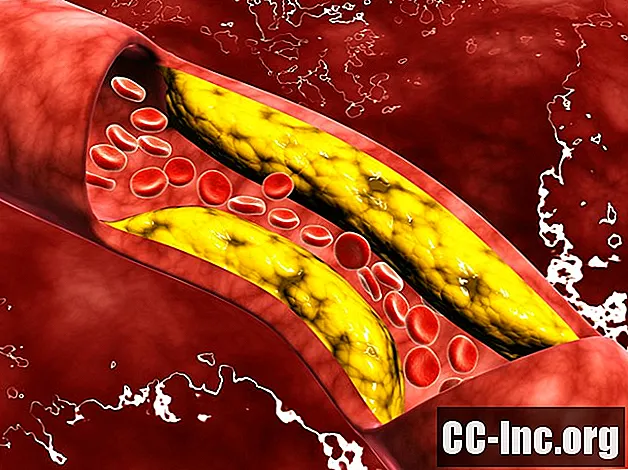 Pemeriksaan Hipotesis Kolesterol