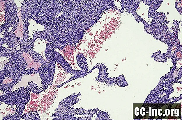 Gambaran Keseluruhan Angiosarcoma Payudara - Ubat