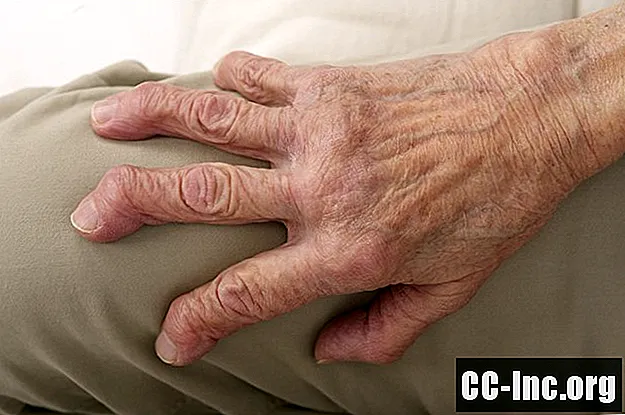 Ein Überblick über Arthritis Mutilans
