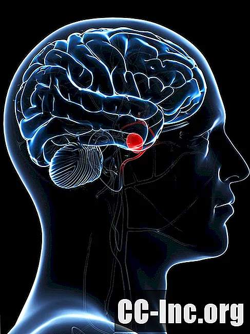 Katsaus aivojen aneurysmiin - Lääke