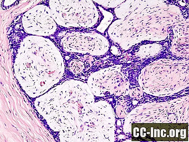 Una descripción general de los fibroadenomas mamarios