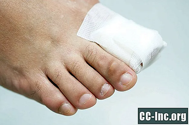 Un aperçu des problèmes courants des ongles des pieds