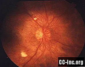 Pregled diabetične retinopatije