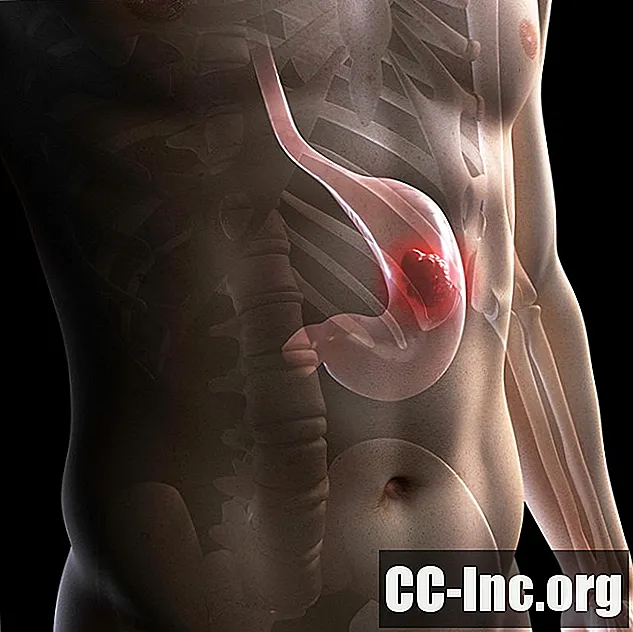 Ein Überblick über den gastrointestinalen Stroma-Tumor