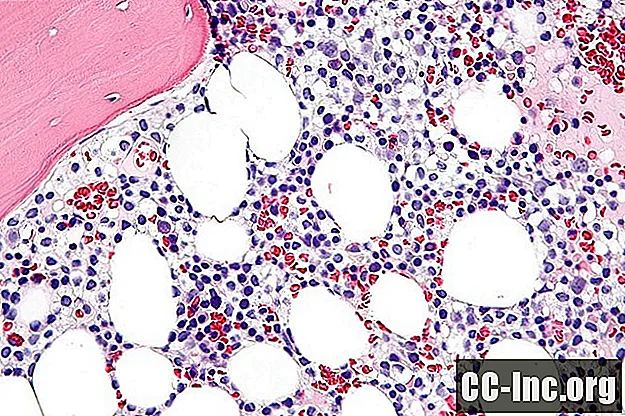 Pregled leukemije dlakavih stanica