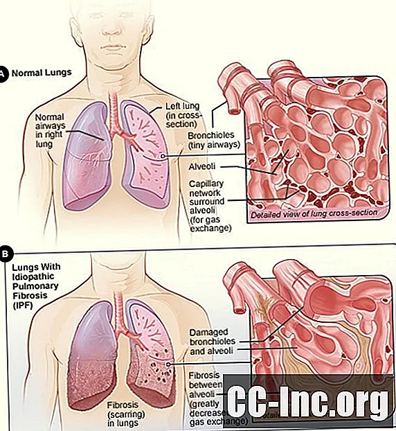 Ein Überblick über die idiopathische Lungenfibrose