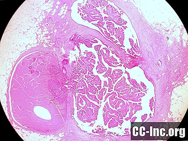 Een overzicht van intraductale papillomen in de borst