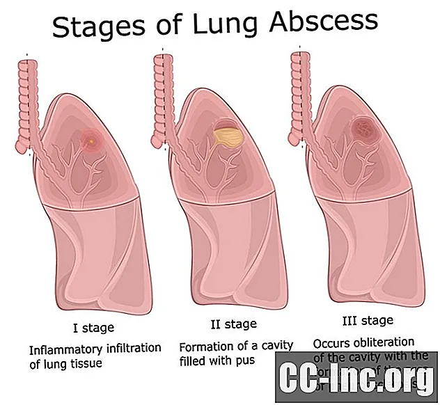 Огляд абсцесу легенів