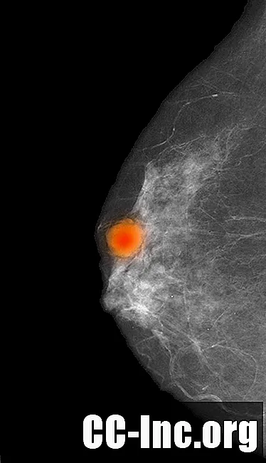 Μια επισκόπηση του βλεννογόνου καρκινώματος του μαστού