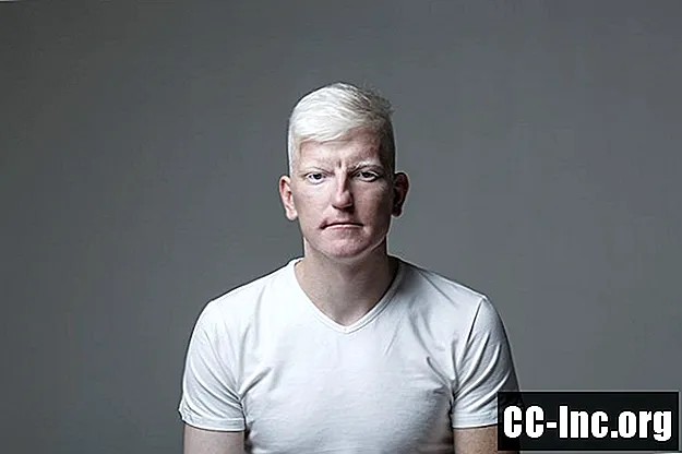 Az Oculocutan Albinism áttekintése - Gyógyszer