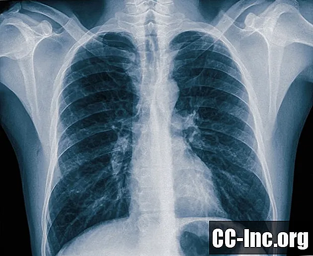 Una panoramica del pneumotorace nei polmoni