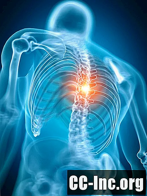 סקירה כללית של דחיסת חוט השדרה