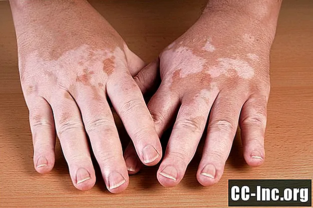 Vitiligo'ya Genel Bakış