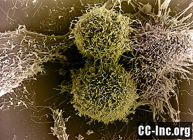 Tổng quan về ung thư tế bào lớn Anaplastic (ALCL)