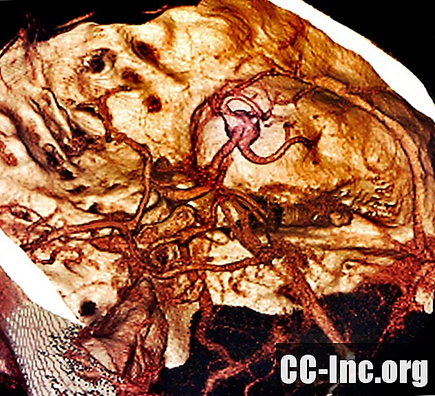 Anatomi av midtre hjernearterie (MCA)